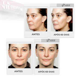 Massageador Facial de Microcorrente - FaceLift